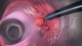 Click to see image detail polyps.jpg