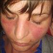 Click to see image detail Lupus.jpg